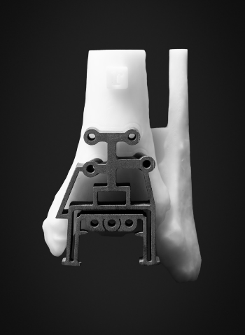 Implant on ankle bone model